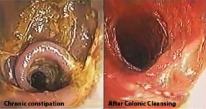 chronic constipation